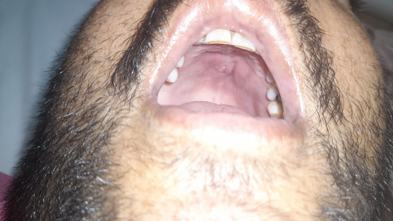 موکور مایکوزیس, Other