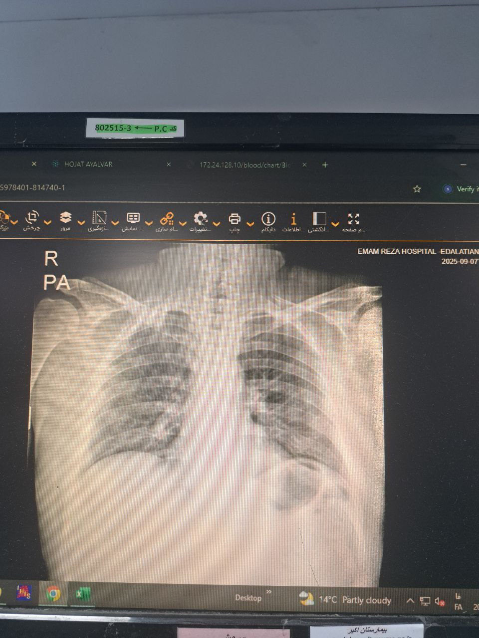موکور مایکوزیس, X-Ray