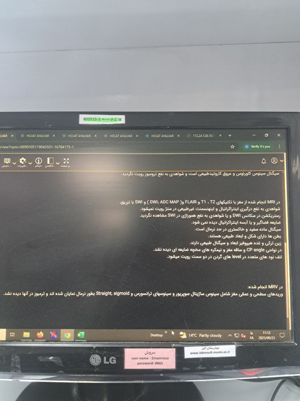 موکور مایکوزیس, Other