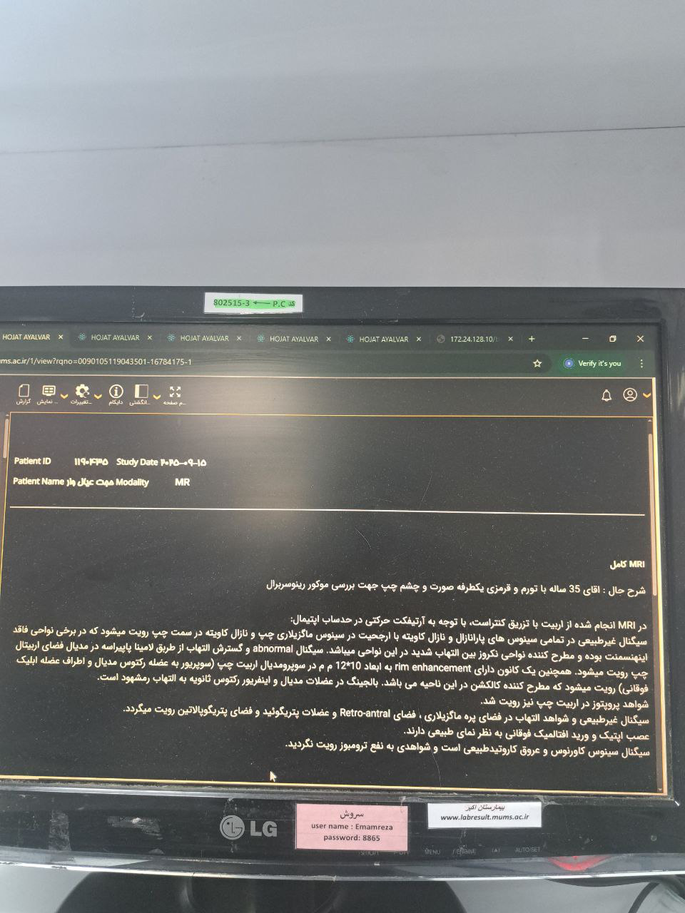 موکور مایکوزیس, Other