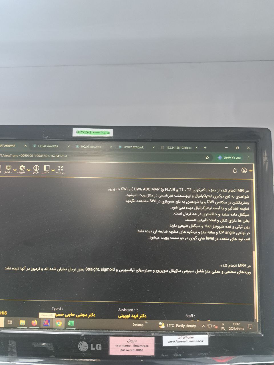 موکور مایکوزیس, Other