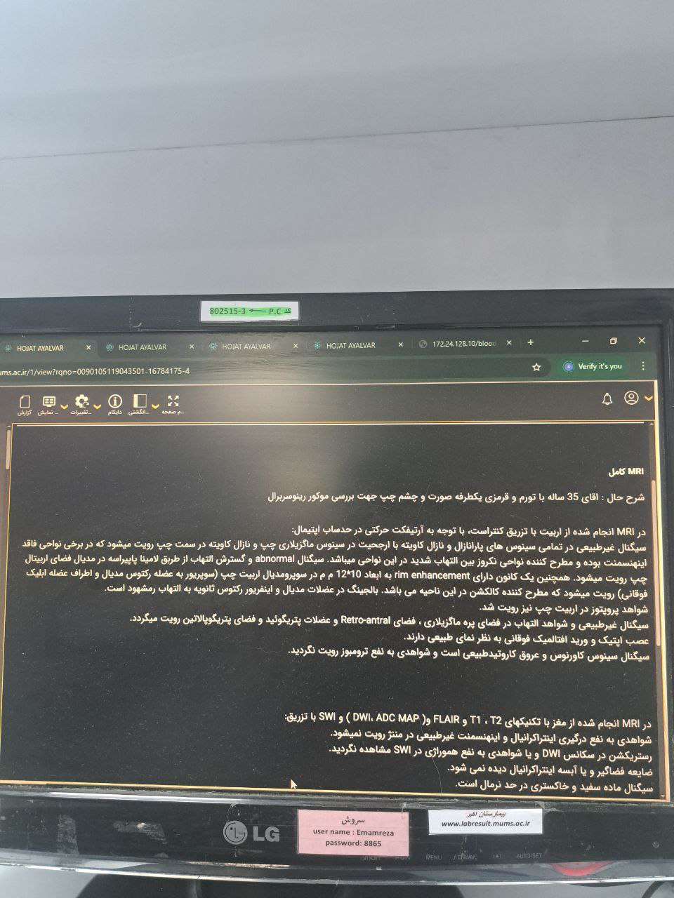 موکور مایکوزیس, Other