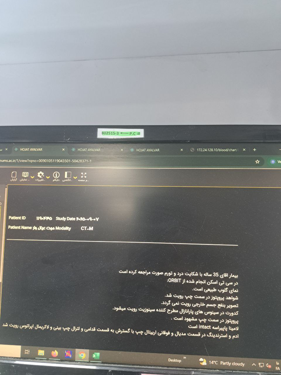 موکور مایکوزیس, Other