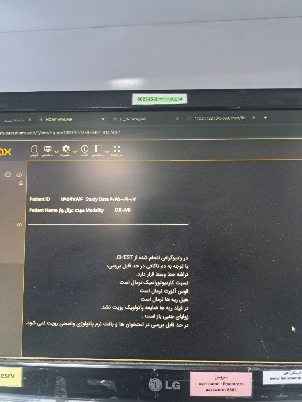 موکور مایکوزیس, Other