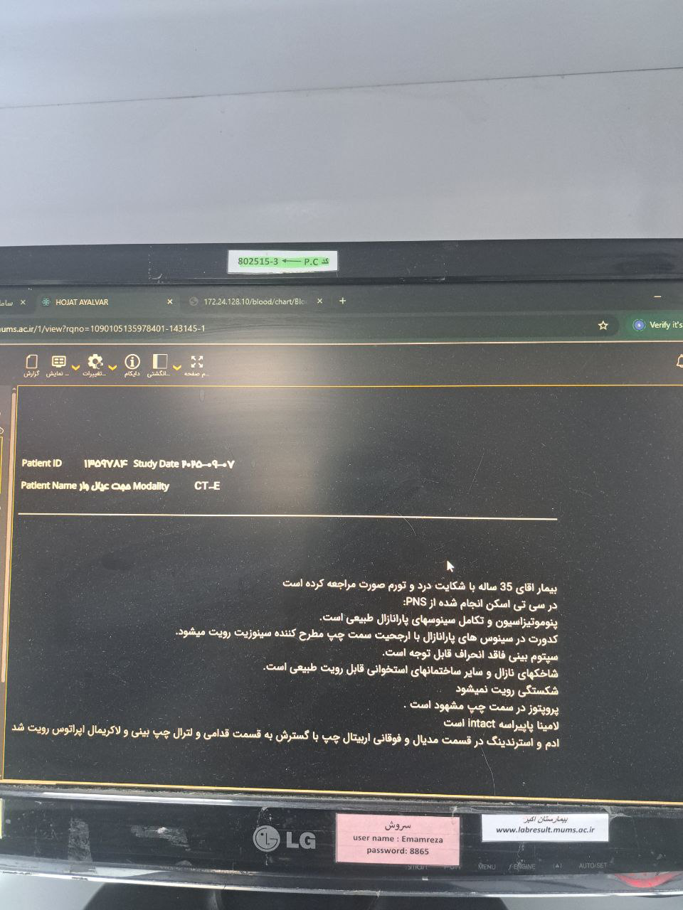 موکور مایکوزیس, Other